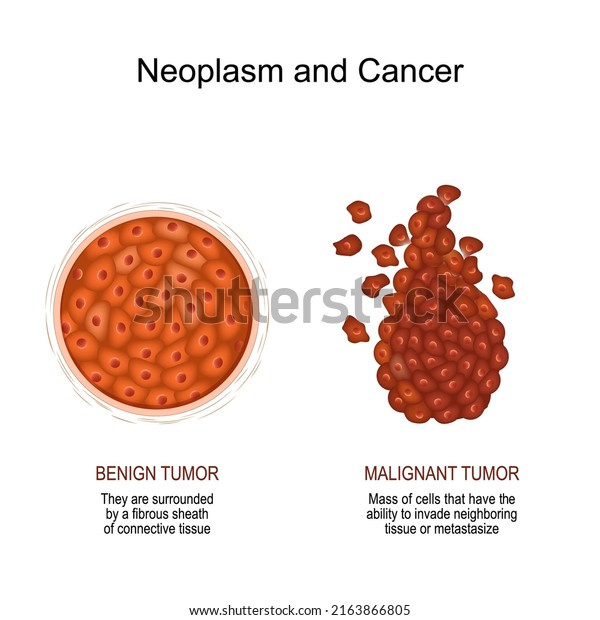 Neoplasm and Cancer. Comparison and difference of\
a malignant and benign tumor. benign tumor surrounded by a fibrous\
sheath of connective\
tissue.