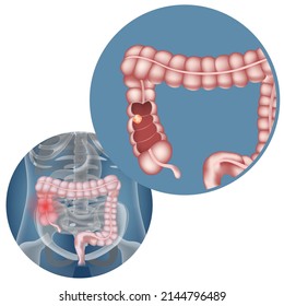 Neoplasm in the intestine. Disease infographics. Realistic rendering of the human body and internal organs. Vector illustration