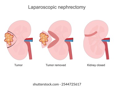 Nephrectomy is a major procedure performed to remove renal tumours or non-functioning kidneys.It treats kidney cancer or removes a healthy kidney.Kidney removal, medical healthcare