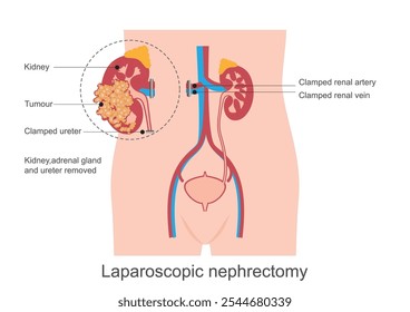 Nephrectomy is the surgical removal of a kidney. It treats kidney cancer or removes a healthy kidney for transplant.Kidney removal, medical healthcare, vector illustration.