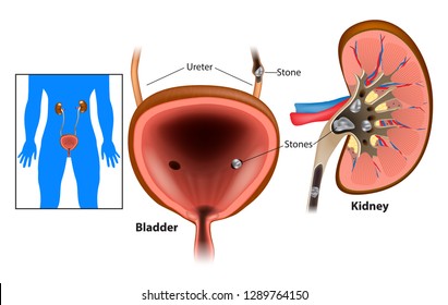 Nephrolithiasis Kidney Stones Disease Or Urolithiasis. Renal Calculus Or Stones Blocking The Urinary Tract.