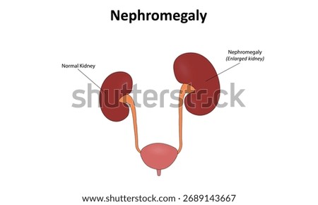 Nephromegaly (Enlarged kidney) vector illustration	
