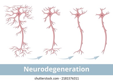 Neurodegeneration. Degeneration Of A Nerve Cell, That Occurs Because Of Multiple Sclerosis, Parkinson's Disease, Alzheimer's Disease, Huntington's Disease, Multiple System Atrophy, And Prion Diseases.