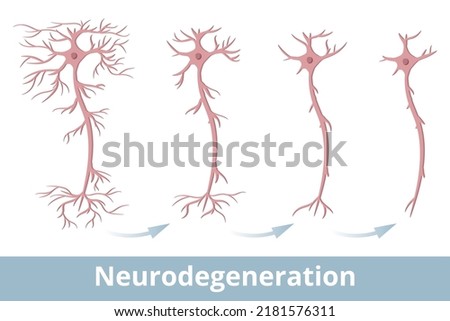 Neurodegeneration. Degeneration of a nerve cell, that occurs because of multiple sclerosis, Parkinson's disease, Alzheimer's disease, Huntington's disease, multiple system atrophy, and prion diseases.