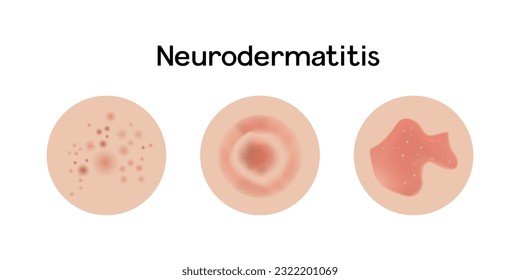 Neurodermatitis examples vector illustration design, allergic problems