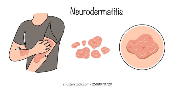 Neurodermatitis. A skin disease characterized by a rash and constant unbearable itching of the skin. Dermatology vector. A simple illustration for different uses.