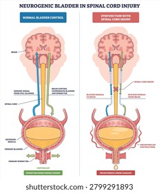 Neurogenic bladder overview shows brain, spinal cord, and bladder pathways, contrasting normal control with injury-related dysfunction and leakage. Outline diagram
