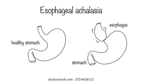 Enfermedad neurogénica basada en la alteración de la motilidad del esófago. La parte inferior del esófago no se relaja lo suficiente a medida que el alimento se mueve a través de él. Simple ilustración en blanco y negro.