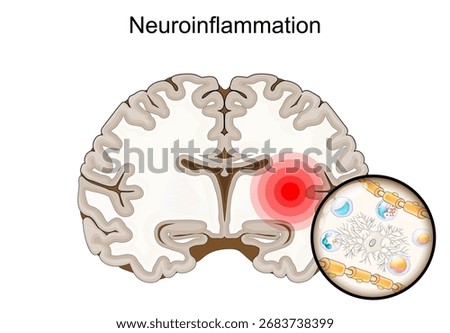 Neuroinflammation. Cross section of human brain with inflammation. Close-up of white blood cell, microglial, neurons and immune cell infiltration. Central nervous system inflammation. Memory loss