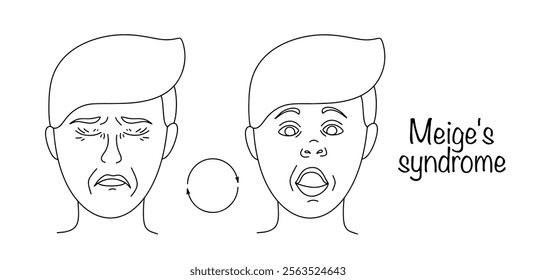 A neurological disease characterized by a combination of blepharospasm and oromandibular dystonia. A drawn fictitious face with symptoms of a disease. Meige's syndrome. Vector.