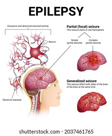 neurological disorders, epilepsy, generalized and partial epileptic seizure, sectional brain and neurons, medical illustration