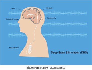 Neuromodulation with deep brain stimulation or DBS at subthalamic nucleus for treatment of Parkinson's disease. Illustration of medical equipment and neural signal.