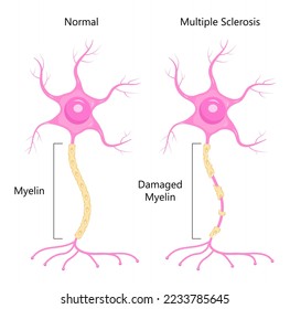 Neuron concept vector. Dendrite, axon, soma of neuron. Multiple sclerosis, nerve anatomy illustration. Myelin and nucleus of brain cell.