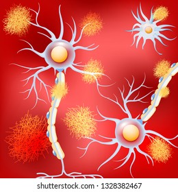 Neurons in the brain with Alzheimer's disease, and amyloid plaques. Vector background. Alzheimer's disease is the change in tau protein that results in the breakdown of microtubules in brain cells