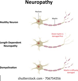 Neuropathy Labelled Illustration