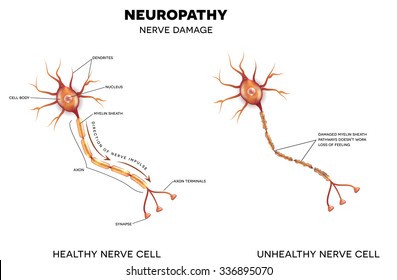 Neuropathy that is the damage of nerves, this can be caused by Diabetes. 