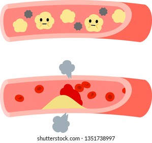 Neutral Fat And Atheroma In Blood Vessels Illustration