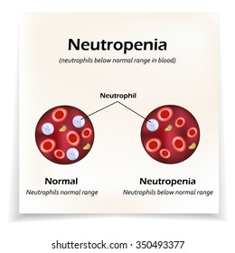 Neutrophils below the normal range in the blood. Neutropenia. Vector illustration.
