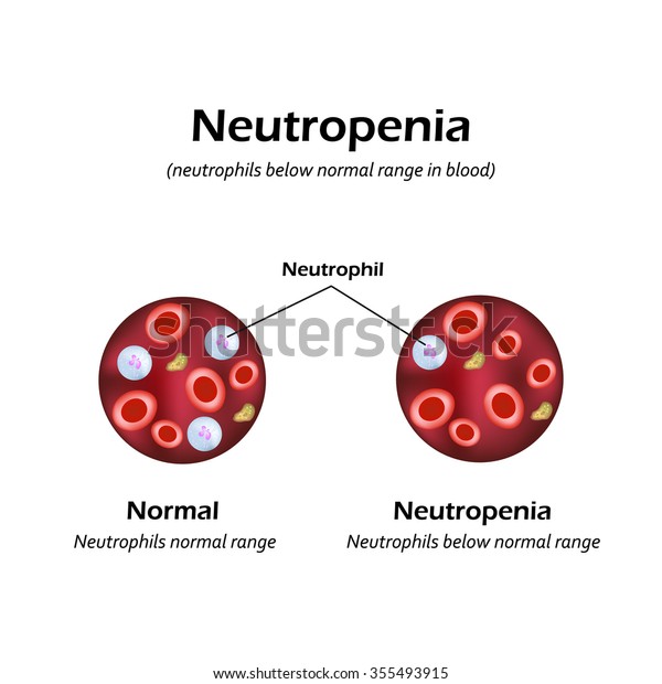 血中正常値以下の好中球 好中球減少症 ベクターイラスト のベクター画像素材 ロイヤリティフリー