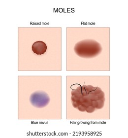 Nevus or mole types. check nevus. Blue nevus, Flat or Raised mole. Hair growing from mole. Poster for Oncology, dermatology and medical use. Vector illustration. 