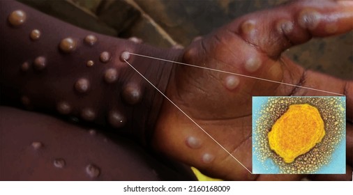 New Monkeypox virus, illustration vector, The spread of the Monkeypox virus as a contagious infection, such as blisters and lesions on the skin, is a virus seen under a microscope. Vestor