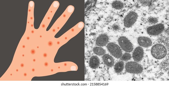 New Monkeypox virus, monkeypox microscope vector image with illustrated diseased hand