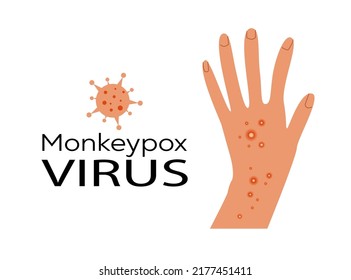 New Monkeypox virus, monkey pox with rashes on the affected arm. Colored flat vector illustartion isolated on white background