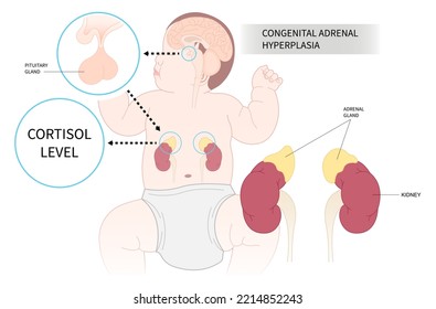 Newborn With Adrenal Disorder That Cause Low Cortisol Level