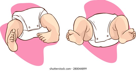 Club Foot High Res Stock Images Shutterstock