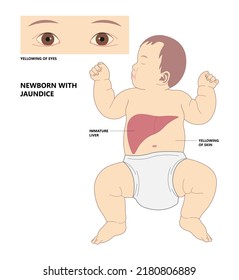 Newborn Jaundice Exchange Transfusion Pediatric Nursing Care Light Therapy Biliary Atresia