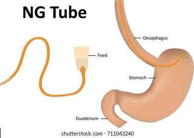 NG Tube Illustration