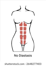 Sem Diástase. Diástase em uma mulher antes, durante e depois da gravidez. A anatomia de uma mulher. O espartilho muscular da mulher antes e depois do parto. Ilustração vetorial

