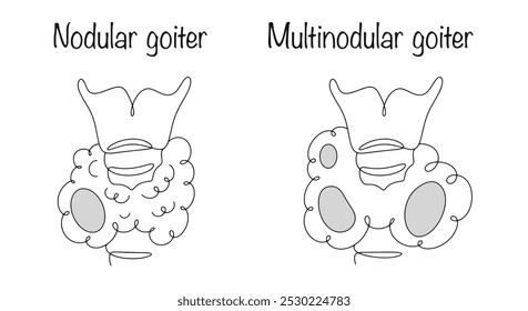 Bocio modular. La aparición de neoplasias nodulares de diferentes tamaños en los tejidos de la glándula tiroides. Ilustración médica sobre un fondo blanco. Ilustración vectorial.