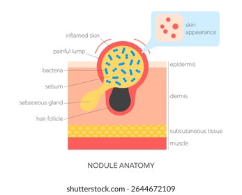 Ilustração do vetor plano da anatomia do nódulo. Infográfico médico mostrando a estrutura da pele, acúmulo de sebo, inflamação e visão superficial. Cuidados com a pele e conceito dermatológico.