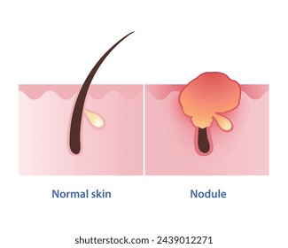Nodule, type of inflammatory acne vector on white background. Normal skin and nodular acne is firm, painful lump to form under your skin and red bump is inflamed to appear on the skin surface.