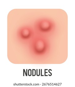 Ilustração do vetor de nódulos. Acne. Vetor 3d clipart