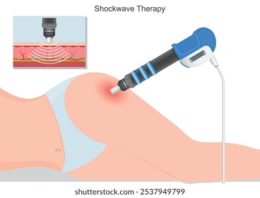 Terapia de ondas de choque extracorpóreas no invasivas (ESWT para abreviar) para los músculos del cuello y la espalda. Promueve el alivio del dolor, la recuperación muscular y la salud de la columna vertebral. Atención médica, Ilustración vectorial.