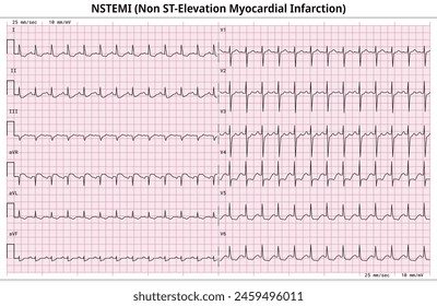 Infarto de miocardio sin elevación del segmento ST (IMSEST) - Papel electrocardiográfico 12 derivaciones - derivación de 6 seg. - Ilustración vectorial médica