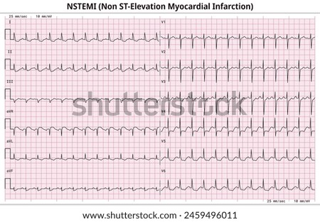 Non ST-Elevation Myocardial Infarction (NSTEMI) - ECG Paper 12 Lead - 6 Sec lead - Medical Vector Illustration