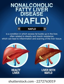 Nonalcoholic fatty liver disease illustration