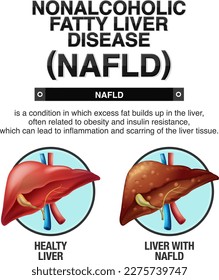 Ilustración de la enfermedad hepática no alcohólica