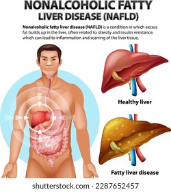Ilustración de la Enfermedad Hepática Grasa No Alcohólica