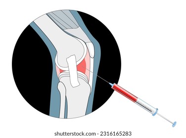 Nichtchirurgische Behandlungen gegen Arthritis. Injektionen in das schmerzhafte Gelenk. Wirksamkeit von Thrombozyteninjektionen oder PRP-Therapie. Verfahren zur Injektion von Hyaluronsäure oder Steroiden und Cortison.