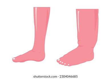 normal and abnormal foot. edema foot illustration for education. eps 10