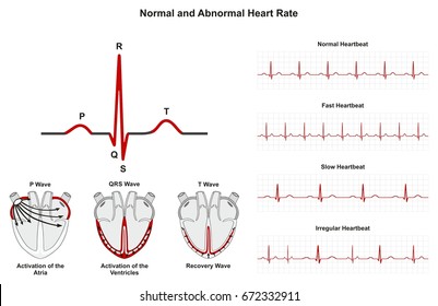 Normal and Abnormal Heart Rate infographic diagram including activation of atria ventricle recovery wave also chart of normal fast slow irregular heartbeats for medical science education 
