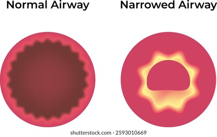 Normal Airway Narrowed Airway Science Design Vector Illustration Diagram