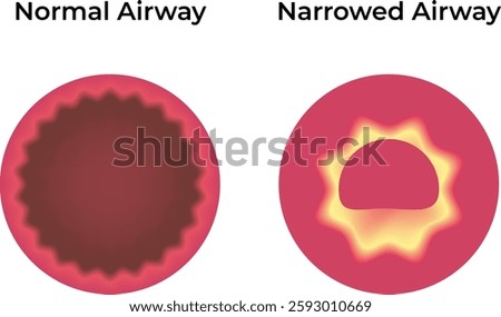 Normal Airway Narrowed Airway Science Design Vector Illustration Diagram