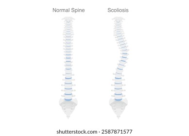 Normal alignment spine and Scoliosis or called spine twists and curves to the side. Medical diagram for comparison, diagnosis and Physical therapy.