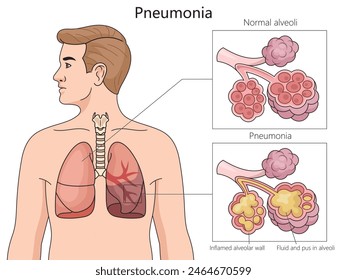 normal alveoli and pneumonia-affected alveoli, highlighting inflamed walls and fluid buildup structure diagram hand drawn schematic vector illustration. Medical science educational illustration