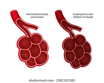 Normal alveoli vs Emphysema Disease